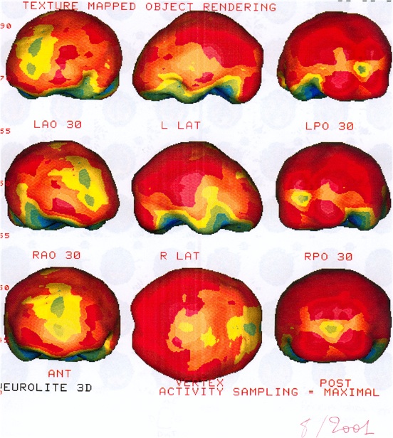 depressionpseudodemence2.jpg