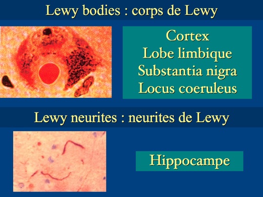 lewybodiesneurites.jpg